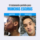 Kit 3 clareadores - Protocolo 90 dias