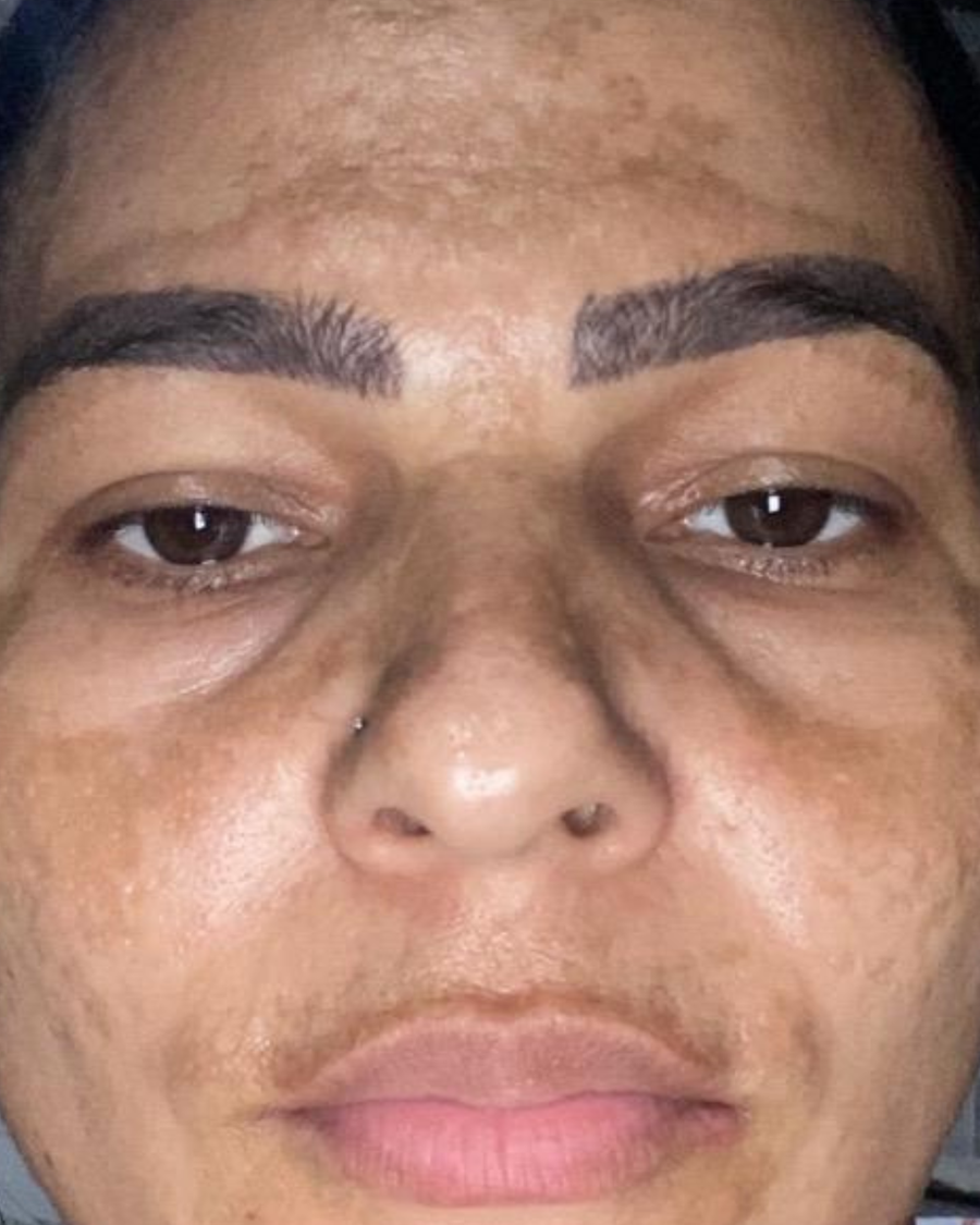 Antes do uso do sérum clareador Skin Tone no rosto - caso 1