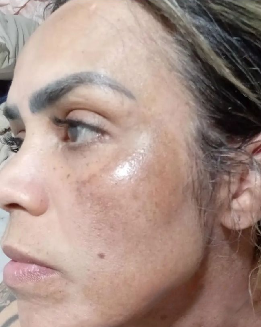 Antes do uso do sérum clareador Skin Tone no rosto - caso 2
