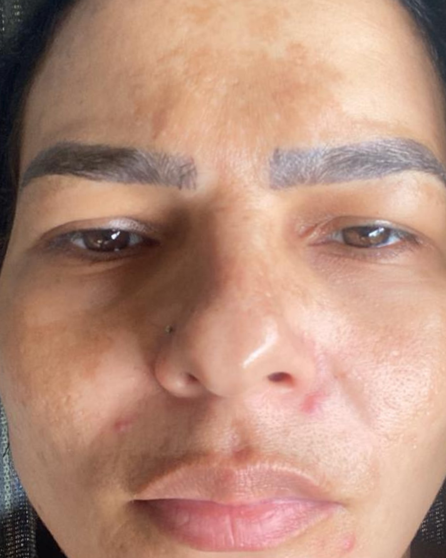 Depois do uso do sérum clareador Skin Tone no rosto - caso 1