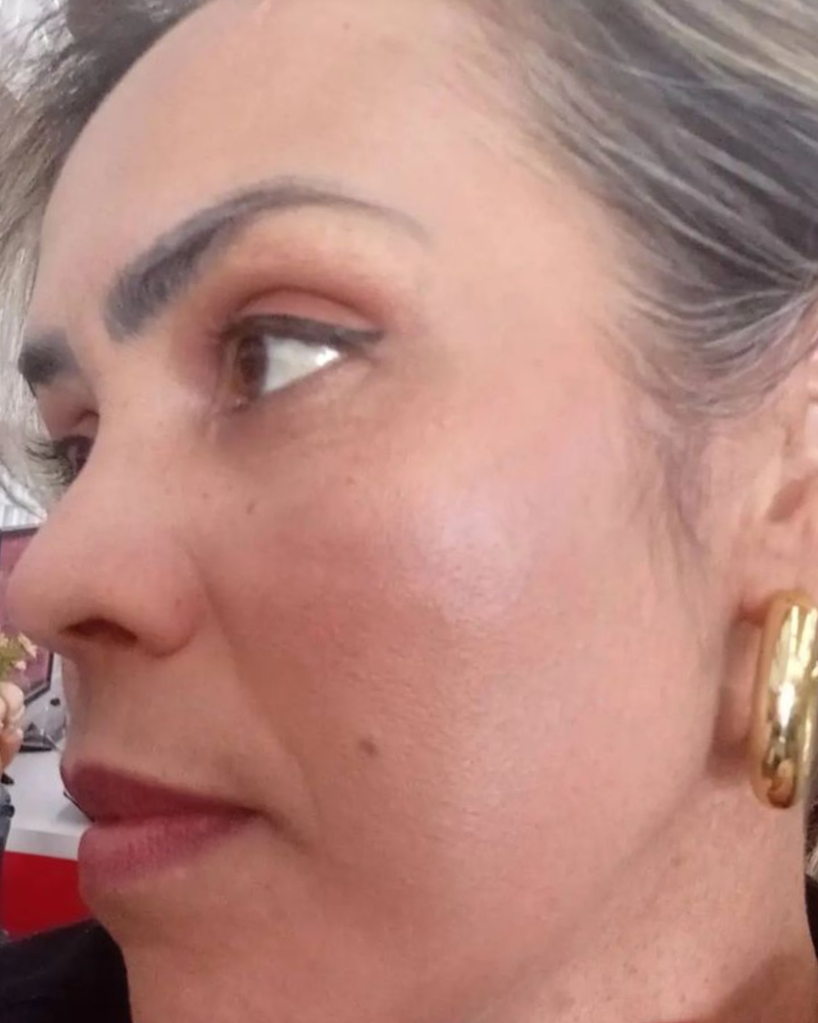 Depois do uso do sérum clareador Skin Tone no rosto - caso 2