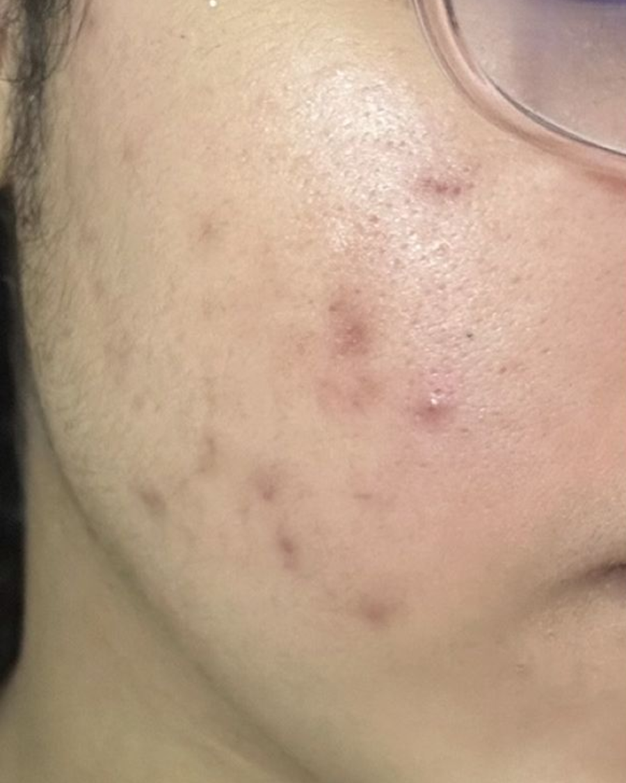 Antes do uso do sabonete facial Skin Tone no rosto - caso 2