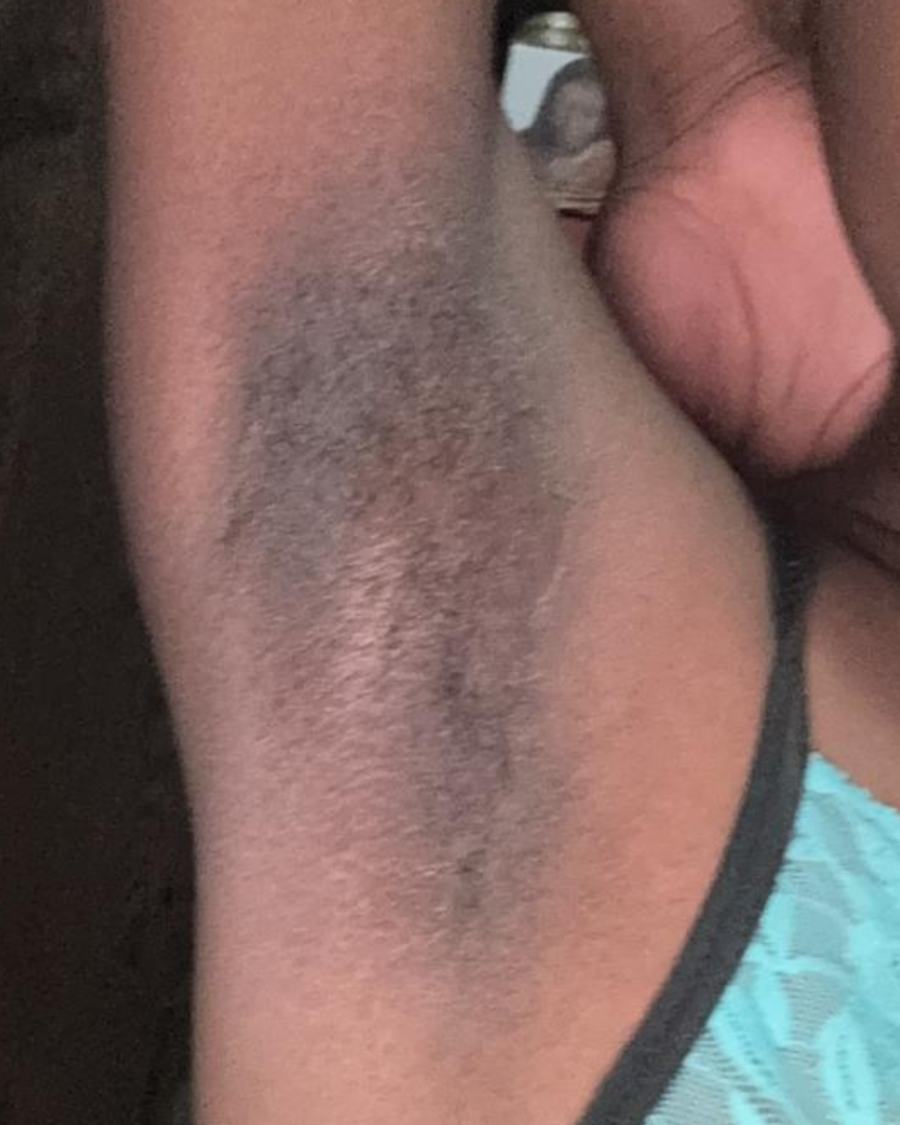 Antes do uso do creme clareador Skin Tone na axila