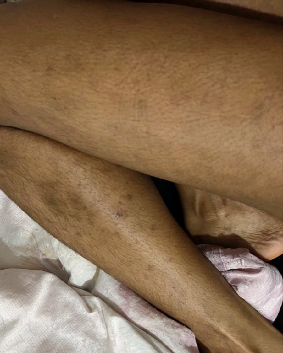 Antes do uso do creme clareador Skin Tone em area do corpo