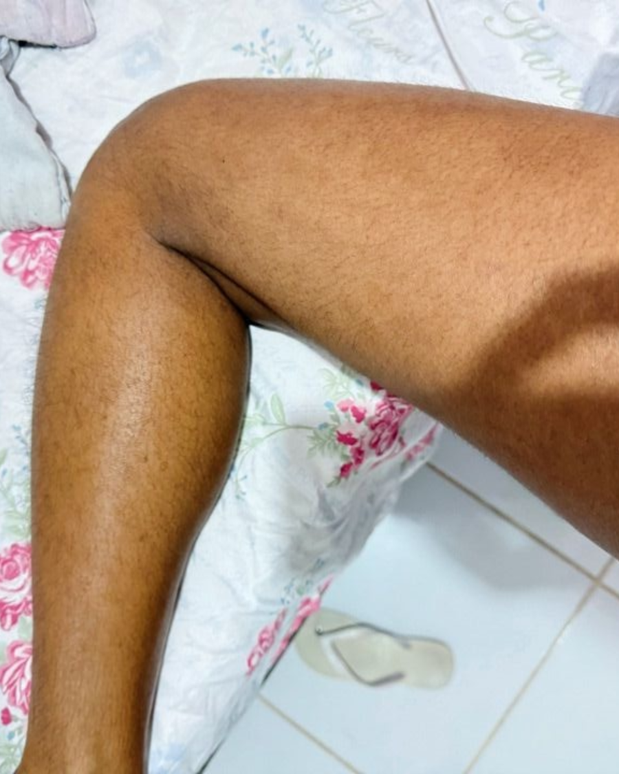 Depois do uso do creme clareador Skin Tone em area do corpo
