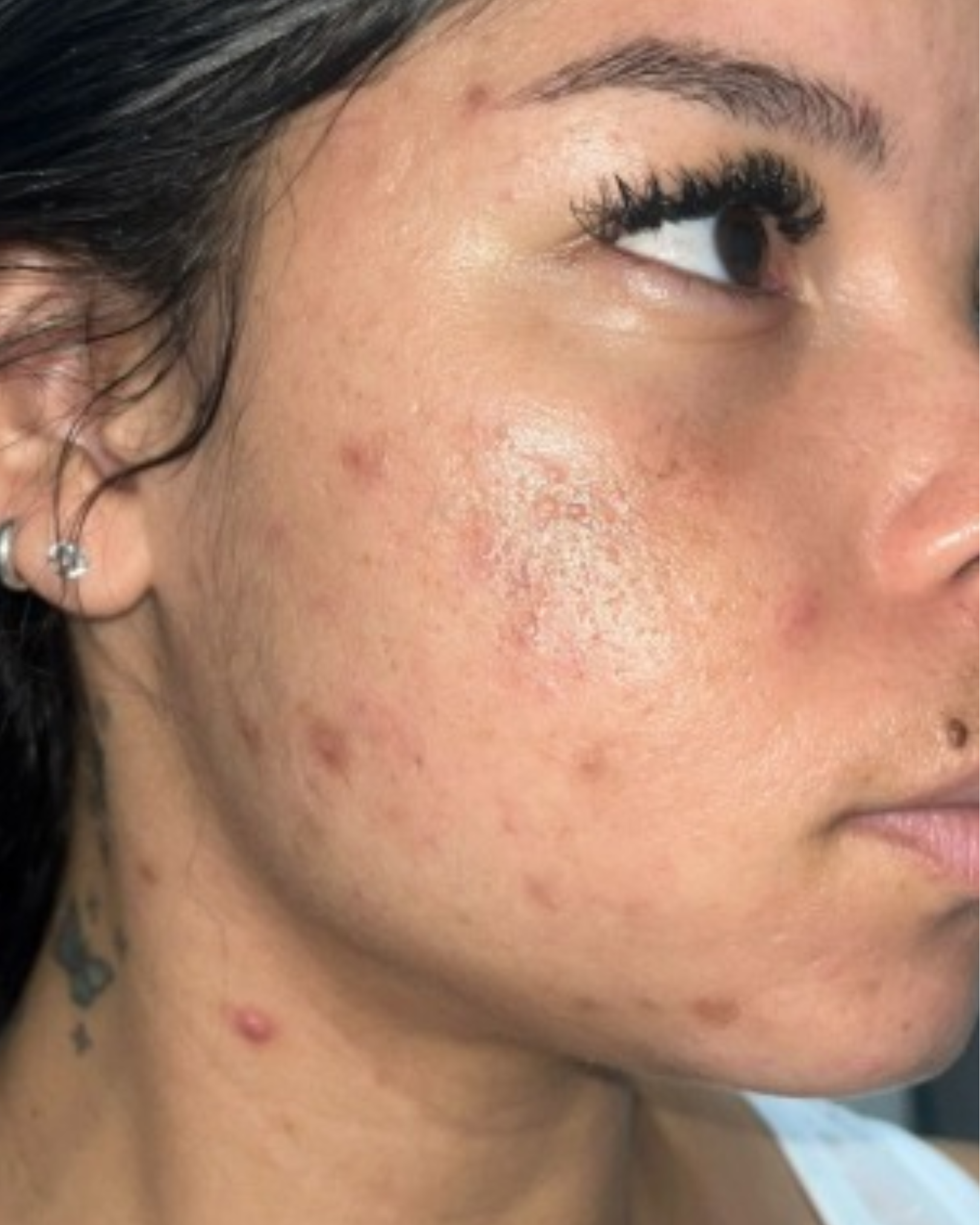 Antes do uso do sabonete facial Skin Tone no rosto - caso 1