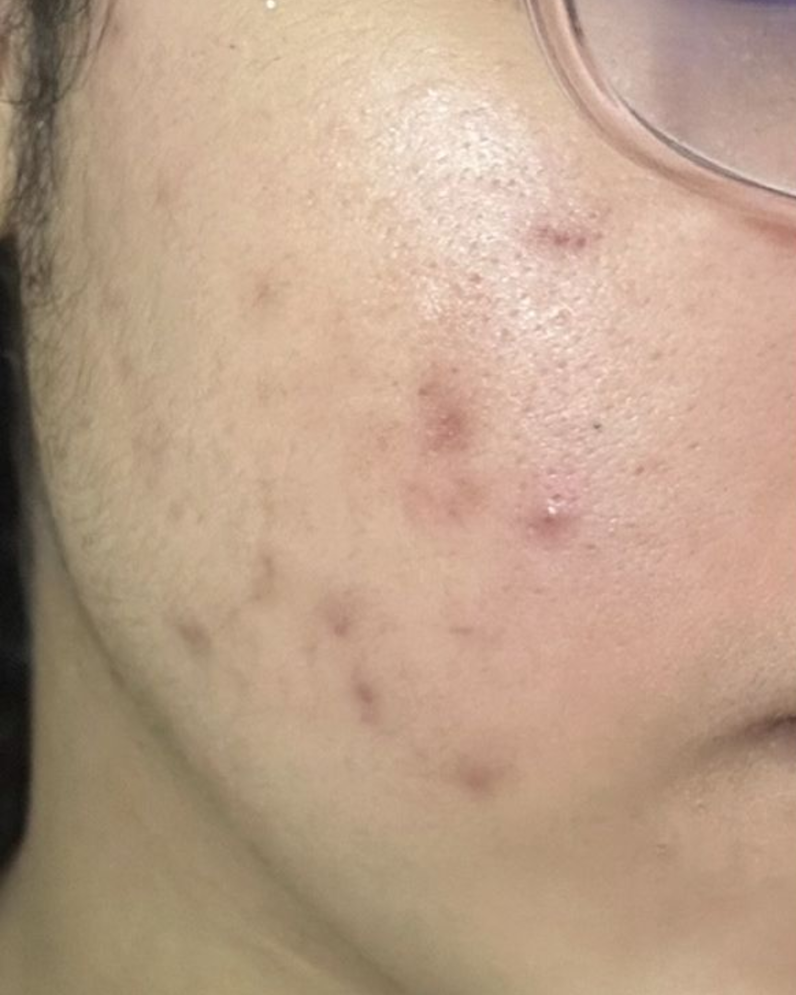 Antes do uso do sabonete facial Skin Tone no rosto - caso 2