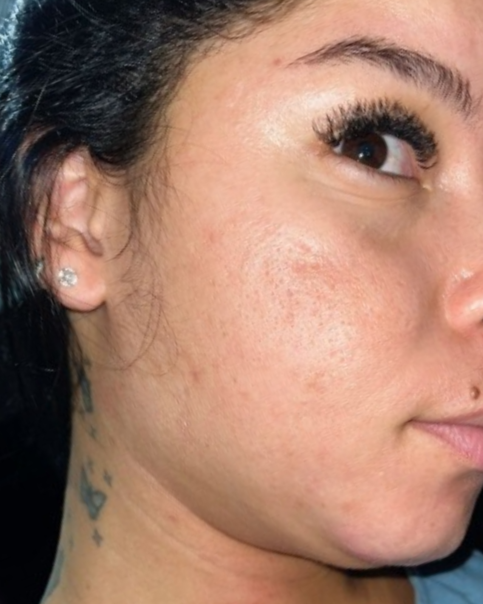 Depois do uso do sabonete facial Skin Tone no rosto - caso 1