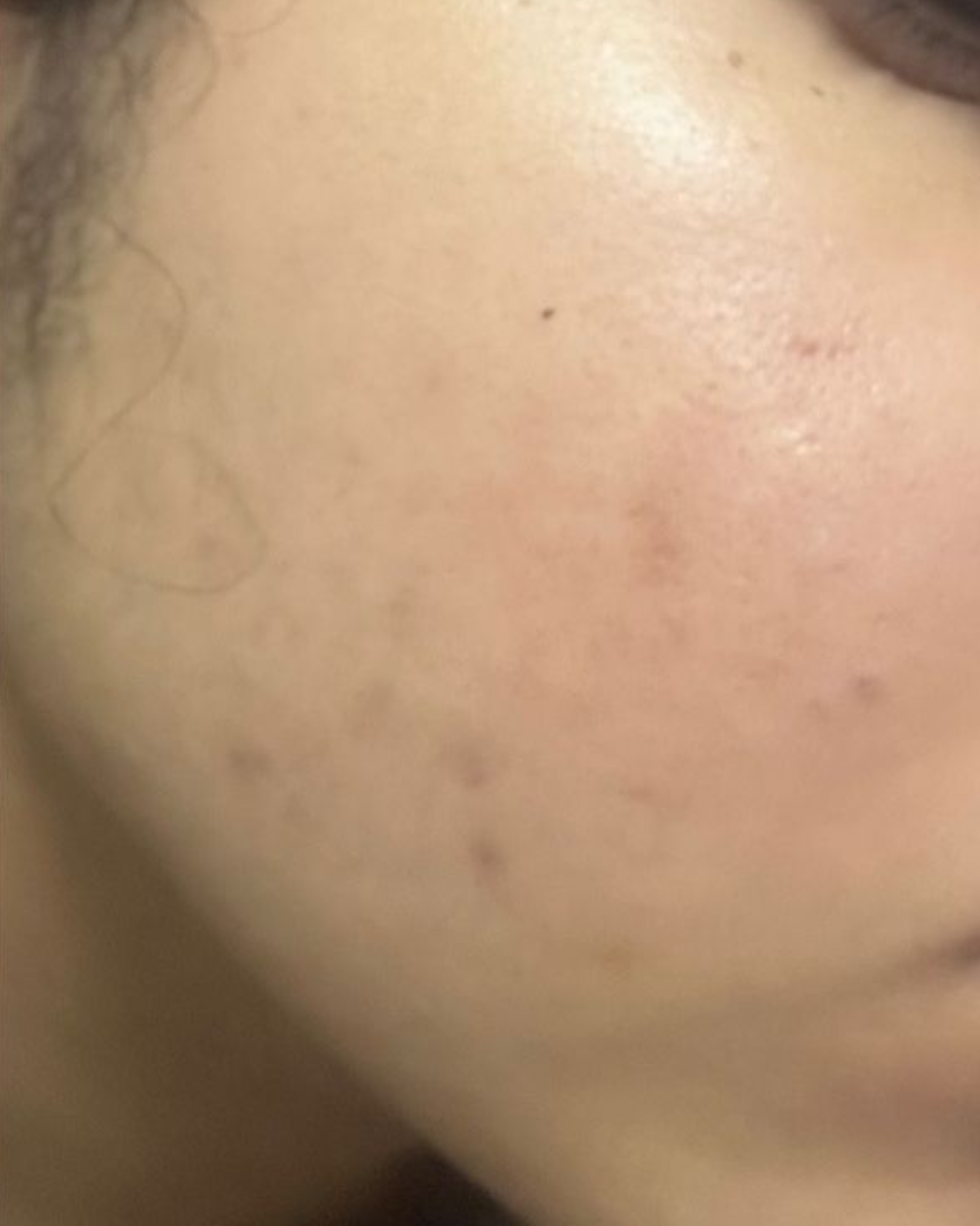 Depois do uso do sabonete facial Skin Tone no rosto - caso 2
